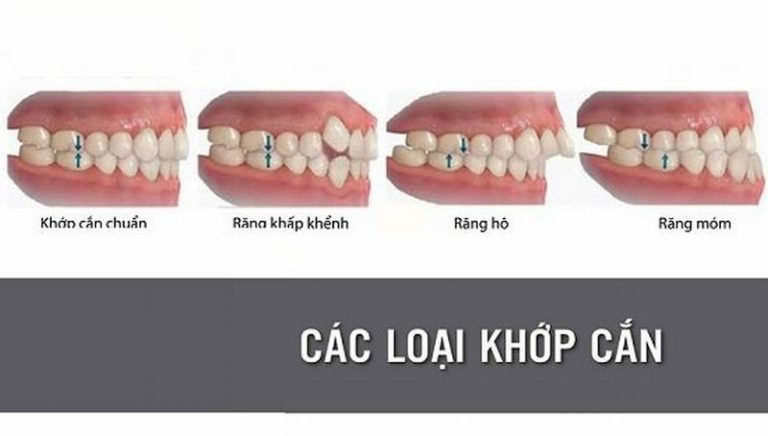 cac-dang-lech-khop-can-va-cach-dieu-tri-rang-lech-khop