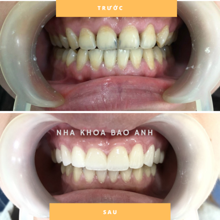 cach-giam-e-buot-sau-khi-lam-rang-su