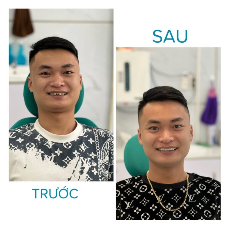 dia-chi-boc-rang-su-dang-tin-cay-tai-duc-trong-lam-dong2