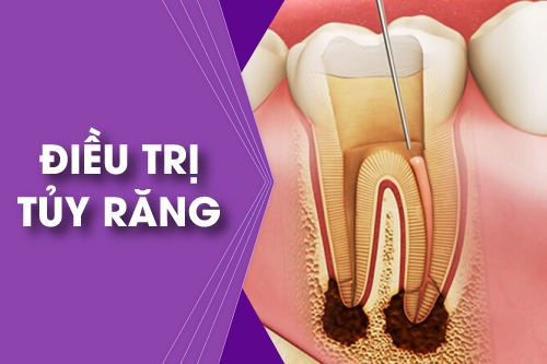 dia-chi-dieu-tri-tuy-rang-tai-duc-trong-lam-dong