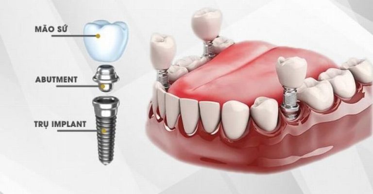 phuong-phap-va-quy-trinh-cay-ghep-implant