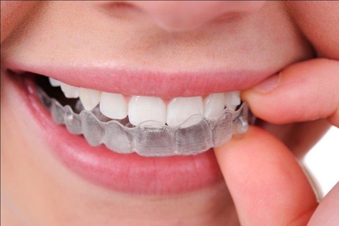 thong-tin-can-biet-ve-nieng-rang-trong-suot-invisalign2