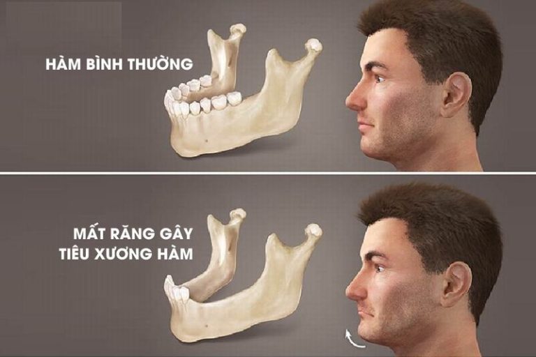 bi-tieu-xuong-ham-sau-khi-mat-rang-va-cach-khac-phuc-hieu-qua