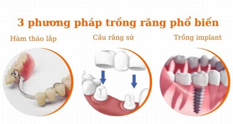 co-nen-trong-rang-gia-va-nhung-phuong-phap-trong-rang-hien-nay2