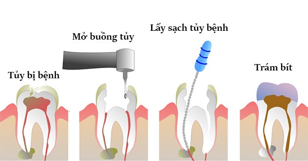 lo-lang-bi-tieu-xuong-sau-khi-lay-tuy-rang2
