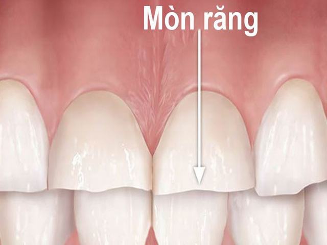 nguyen-nhan-va-cach-dieu-tri-mon-rang-hieu-qua2