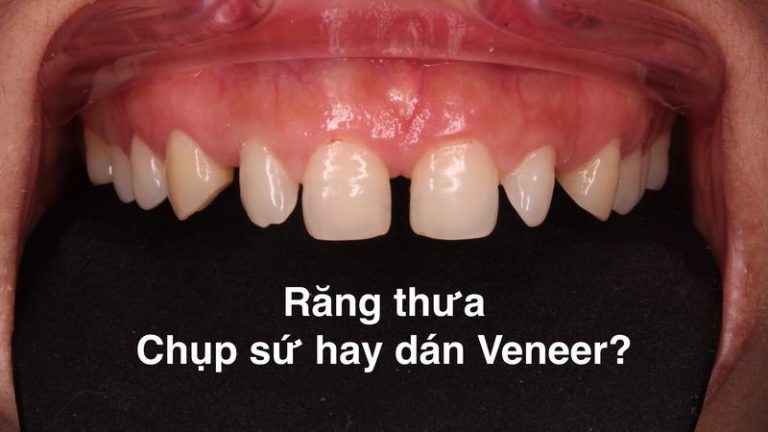 nguyen-nhan-va-giai-phap-khac-phuc-rang-ham-thua-tai-trung-tam-nha-khoa2
