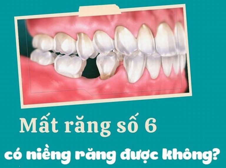 nieng-rang-nhu-nao-voi-rang-so-6-bi-mat