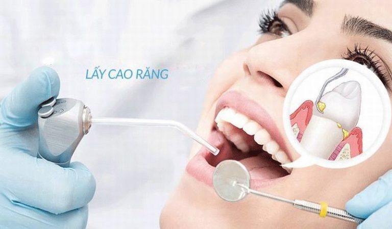 phuong-phap-lay-cao-rang-bang-may-sieu-am-tai-nha-khoa2