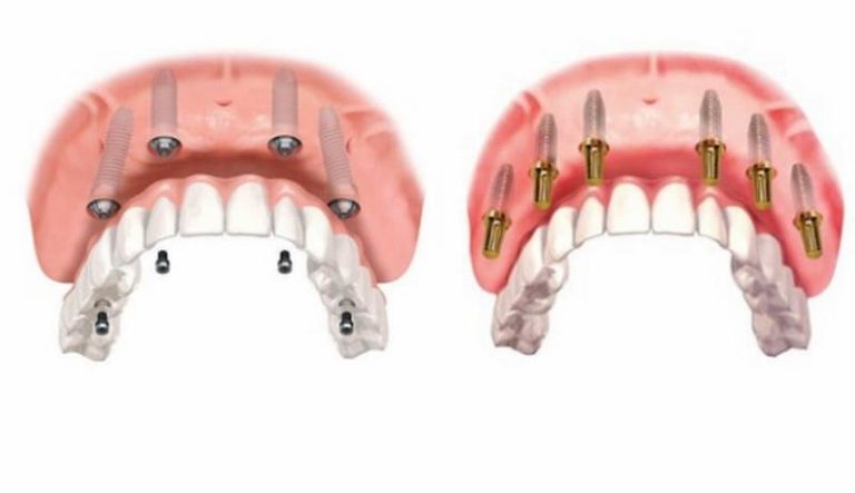 so-sanh-phuong-phap-implant-all-on-4-va-62