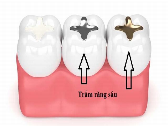 tram-rang-co-anh-huong-gi-toi-suc-khoe2