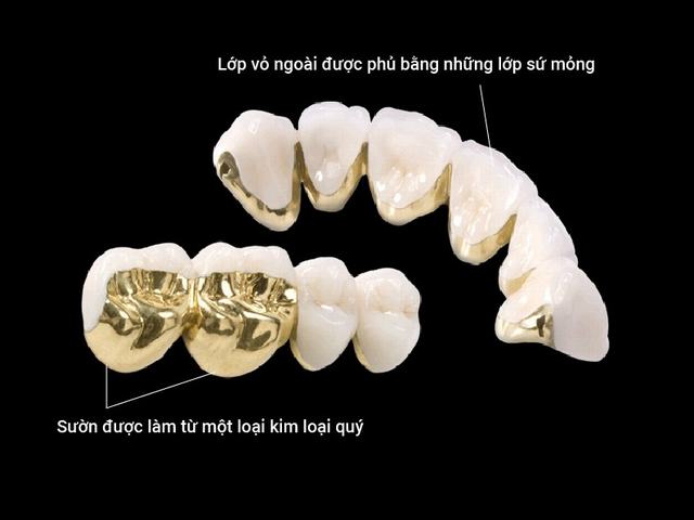 trong-rang-su-kim-loai-o-lam-dong-bao-nhieu-tien2