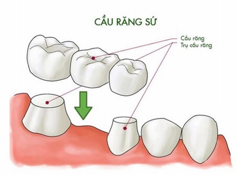 uu-diem-va-nhuoc-diem-cua-viec-lam-cau-rang-su