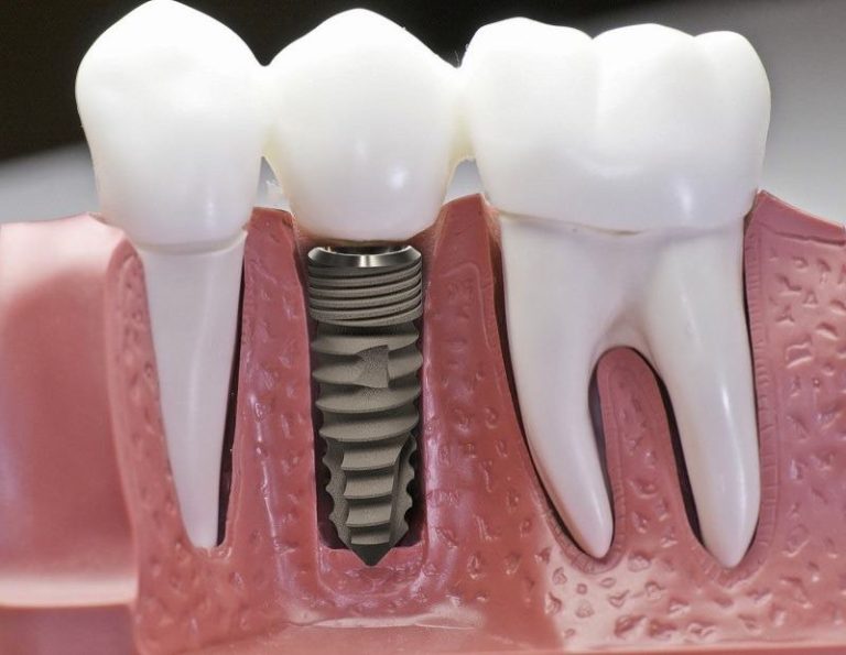 uu-va-nhuoc-diem-khi-gan-rang-implant