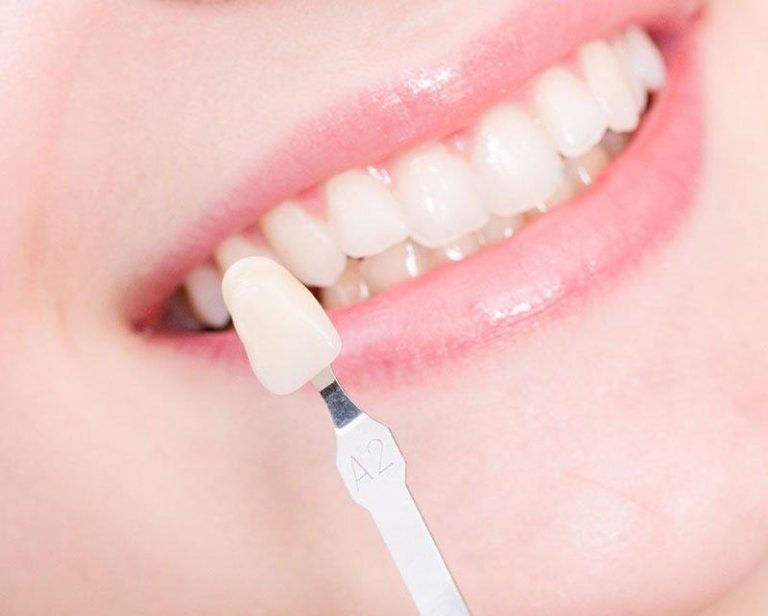veneers-su-la-gi-va-nen-lam-tai-nha-khoa-nao-uy-tin