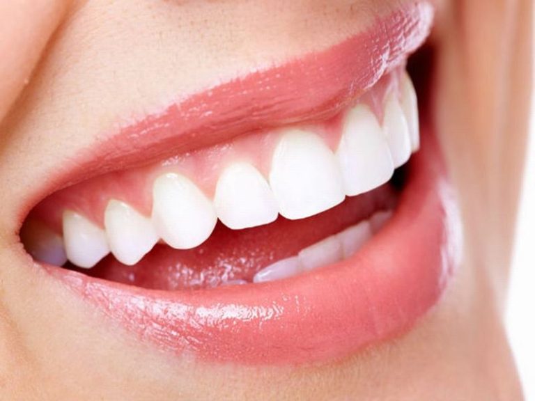 veneers-su-la-gi-va-nen-lam-tai-nha-khoa-nao-uy-tin2