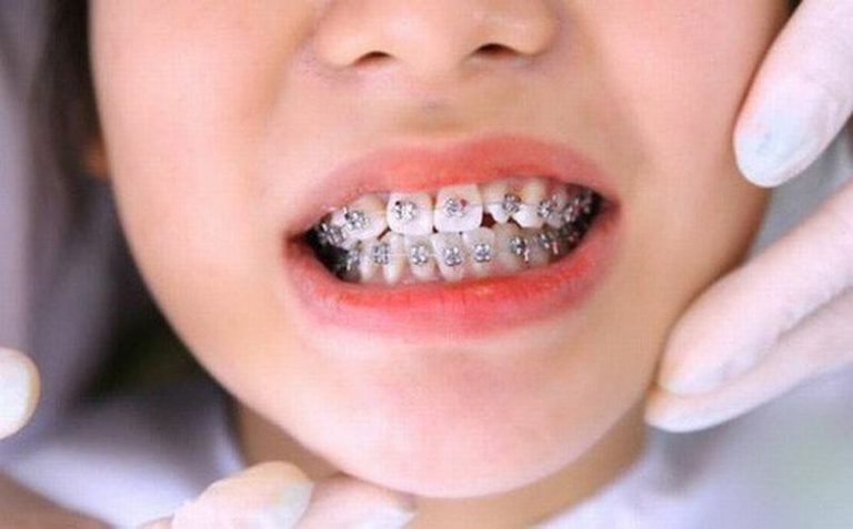 giai-phap-nieng-rang-cho-tre-9-tuoi-hieu-qua