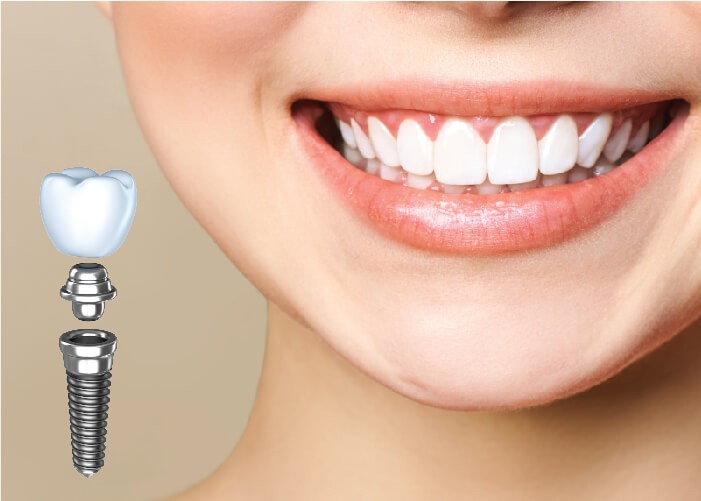 nen-trong-rang-bang-cau-rang-hay-implant