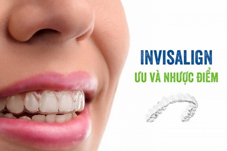 nha-khoa-nieng-rang-trong-suot-invisalign-uy-tin-tai-lam-dong