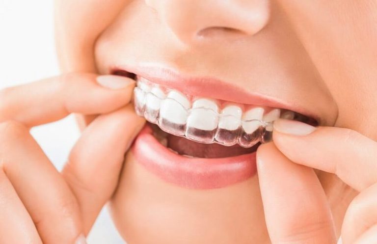 nha-khoa-nieng-rang-trong-suot-invisalign-uy-tin-tai-lam-dong2