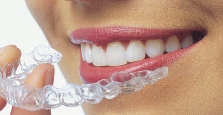 nieng-rang-invisalign-thong-tin-can-biet-truoc-khi-thuc-hien