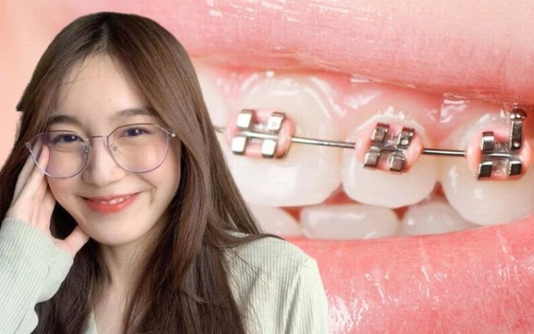 nieng-rang-uy-tin-dich-vu-chat-luong-tai-nha-khoa-bao-anh3