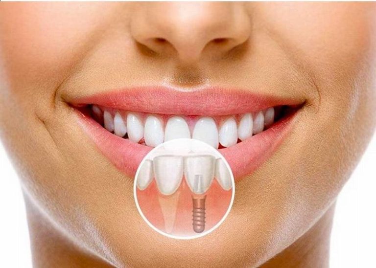 tim-hieu-chi-tiet-ve-phuong-phap-trong-rang-implant2