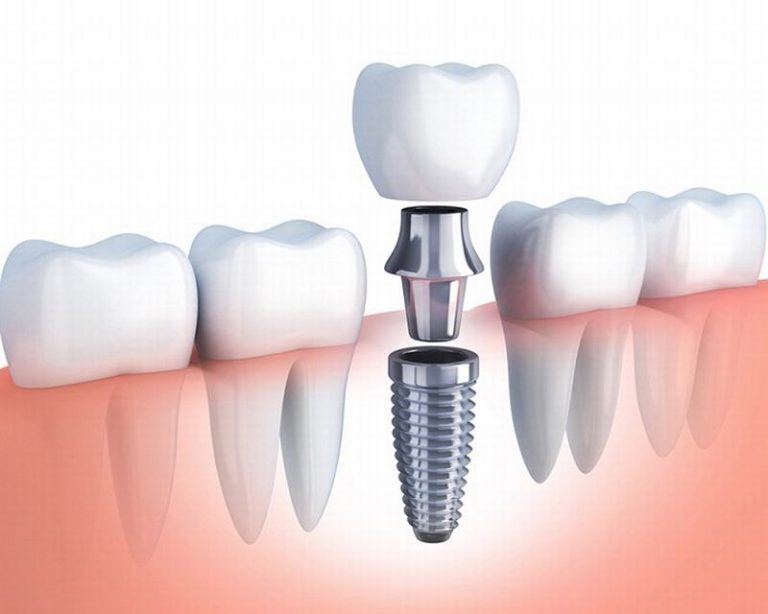 trung-tam-nha-khoa-cay-ghep-implant-uy-tin-tai-lam-dong2