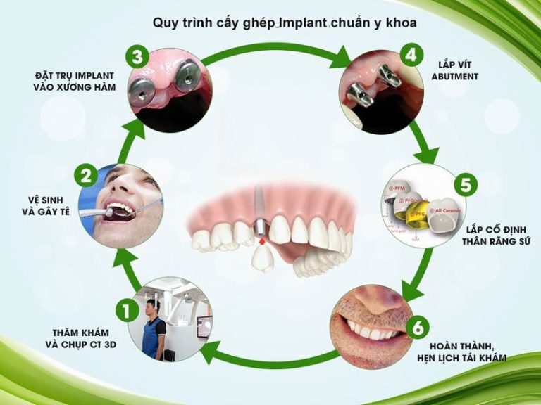 uu-diem-va-cach-cham-soc-sau-khi-cay-ghep-implant
