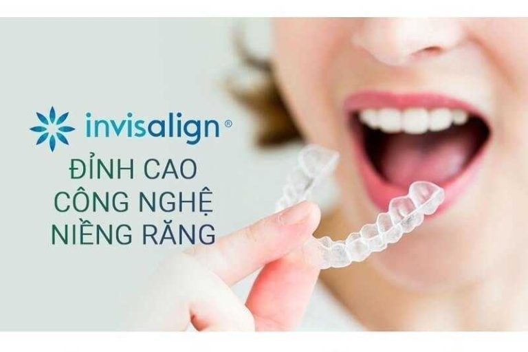 uu-diem-va-chi-phi-nieng-rang-invisalign-hien-nay