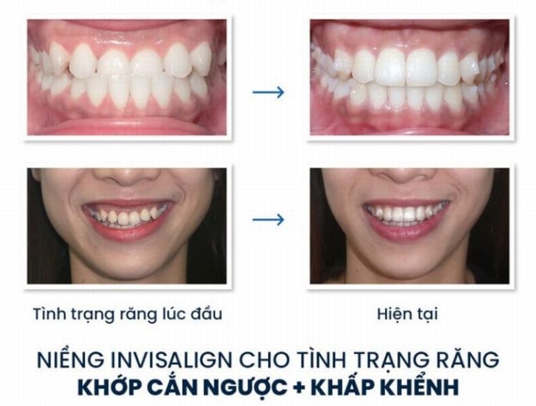 cac-phuong-phap-nieng-rang-khop-can-nguoc2