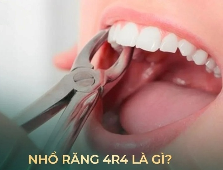 neu-can-nho-rang-4r4-can-luu-y-nhung-gi