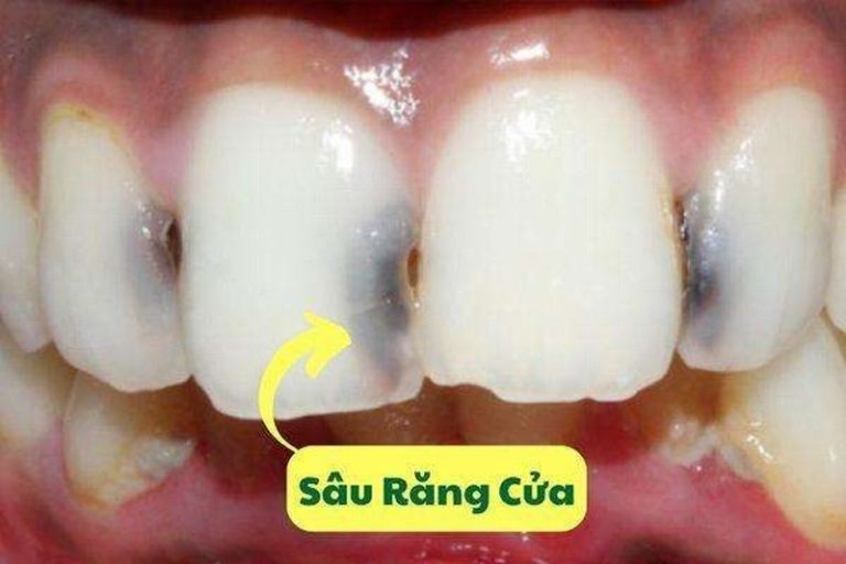 nguyen-nhan-va-cach-dieu-tri-sau-rang-cua-hieu-qua