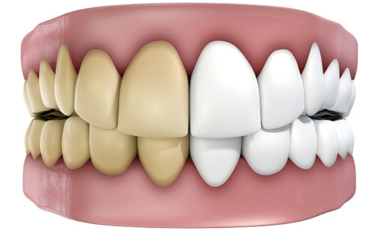 dau-hieu-va-cach-xu-ly-khi-bi-ap-xe-rang