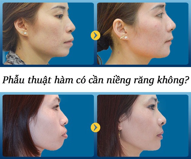 lua-chon-phau-thuat-ham-ho-co-nguy-hiem-khong