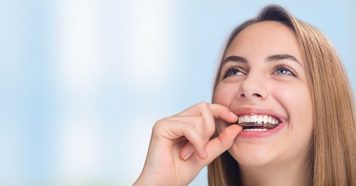 nieng-rang-invisalign-duoc-chi-dinh-trong-truong-hop-nao