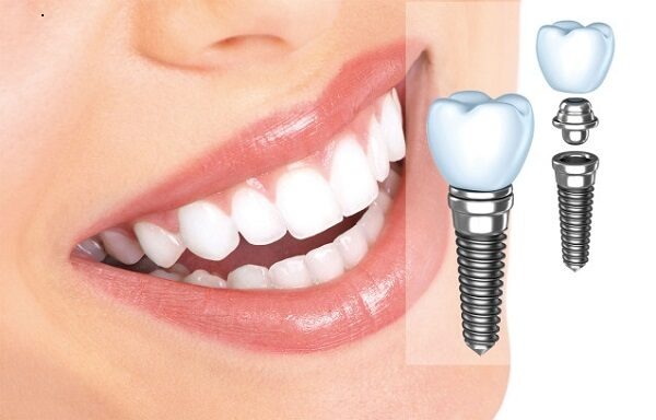 tong-quan-quy-trinh-cam-rang-implant-cho-nguoi-mat-rang2