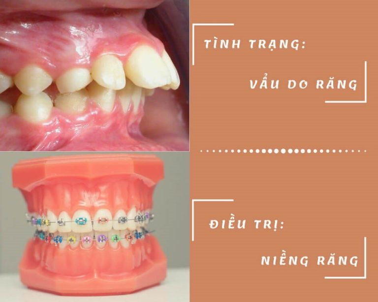 nguyen-nhan-va-cach-chua-rang-bi-vau-hieu-qua2